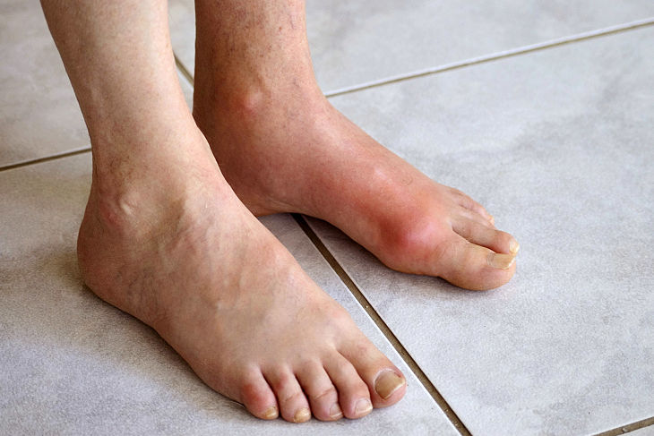 Gout cấp tính gây ra các cơn đau ở mức độ vừa phải