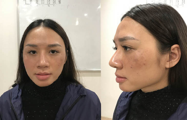 Sau sinh các vết nám, tàn nhang trên da mặt của chị Hương bắt đầu xuất hiện