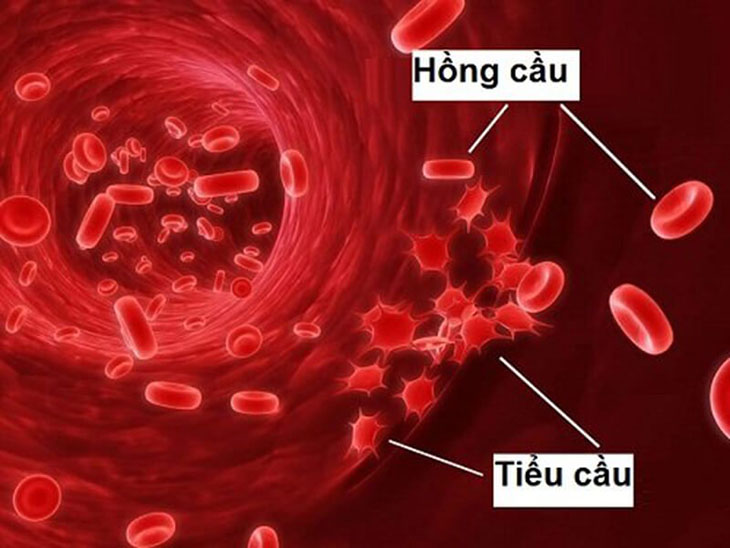 Đái máu có thể do bệnh giảm tiểu cầu, rối loạn đông máu gây nên