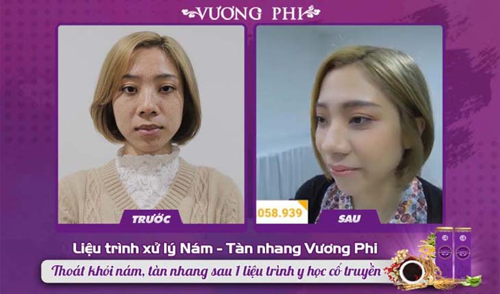 Da mặt của chị Hoài An trước và sau khi dùng Vương Phi