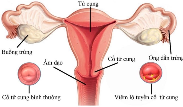 Viêm lộ tuyến cổ tử cung cũng là căn bệnh mà phái nữ không thể xem thường