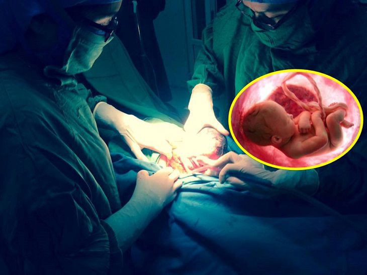Phẫu thuật lấy đứa trẻ trong trường hợp mẹ bầu không đáp ứng được các phương pháp điều trị trên