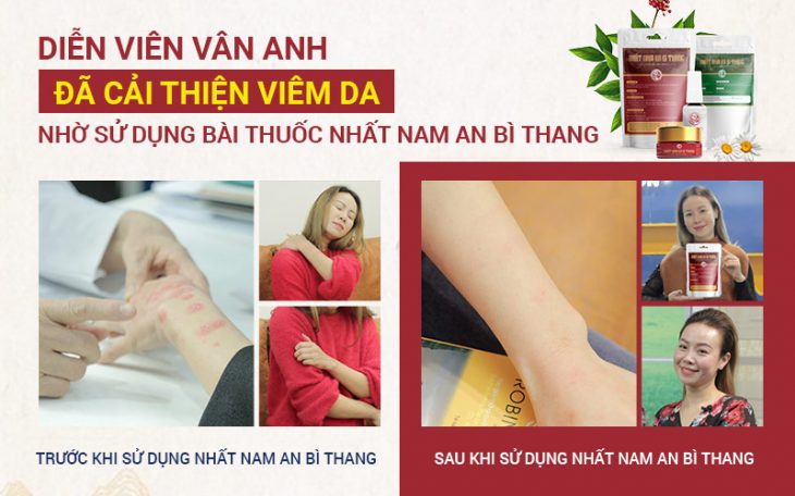 Diễn viên Vân Anh đã nhận về kết quả tích cực sau khi sử dụng bài thuốc Nhất Nam An Bì Thang
