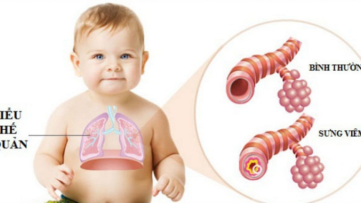 Bệnh viêm phổi trẻ em: Nguyên nhân, chẩn đoán và cách điều trị