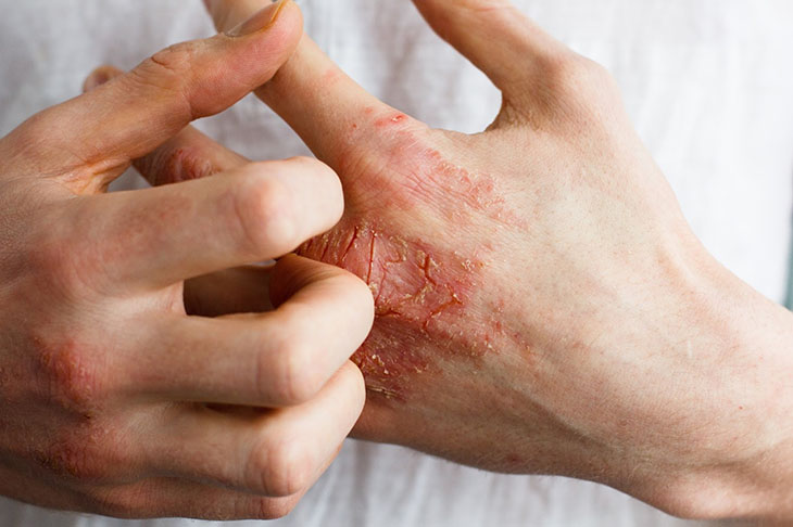 Vi khuẩn tụ cầu vàng sống ký sinh trên da và niêm mạc rồi xâm nhập vào cơ thể qua các lỗ chân lông