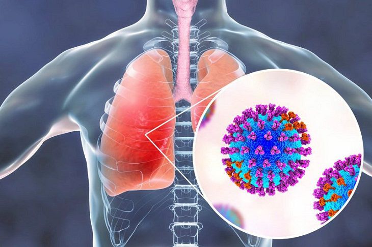 Phác đồ điều trị bệnh viêm phổi nặng do virus cúm A chi tiết