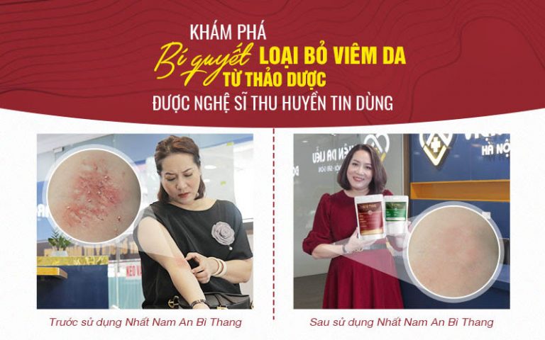 Diễn viên Thu Huyền trước và sau điều trị viêm da với An Bì Thang