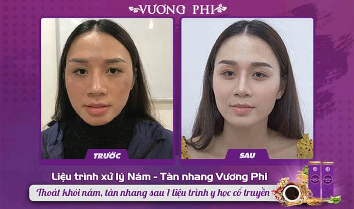 So sánh gương mặt trước và sau khi dùng liệu trình thảo dược Vương Phi của chị Hương