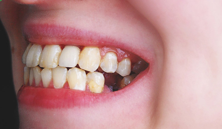 Mất răng có thể gây tác động tới dây thần kinh