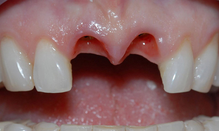 Nhổ răng không trồng lại có sao không? Gây ảnh hưởng tới thẩm mỹ