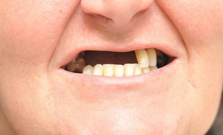 Mất răng dẫn tới lão hóa sớm