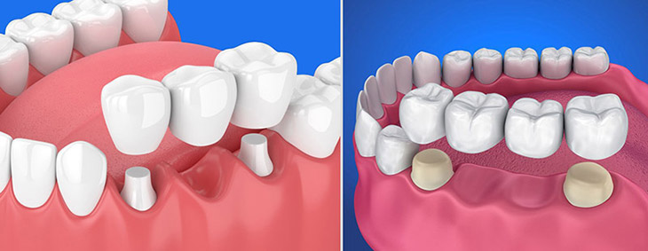 Cầu răng sứ là có khả năng thay thế một hoặc nhiều răng đã mất