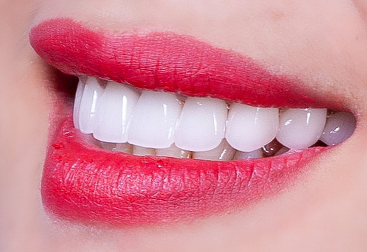 Bọc răng sứ có thể cải thiện được hàm răng nhiều khuyết điểm