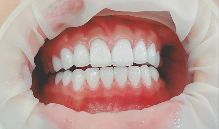 Giúp hạn chế bệnh lý răng miệng