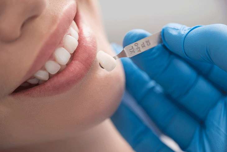 Trồng răng sứ là phương pháp thẩm mỹ phổ biến