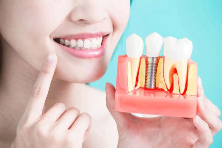 Kỹ thuật trồng răng sứ tác động tới giá cả bọc răng