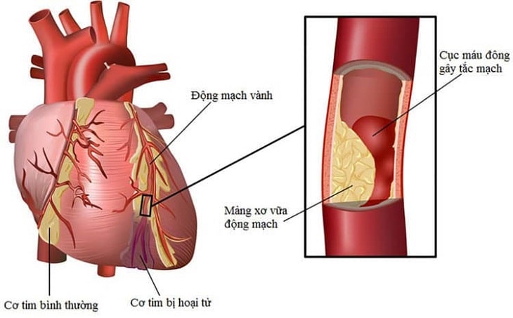 Thiếu máu cơ tim cục bộ là hiện tượng gì