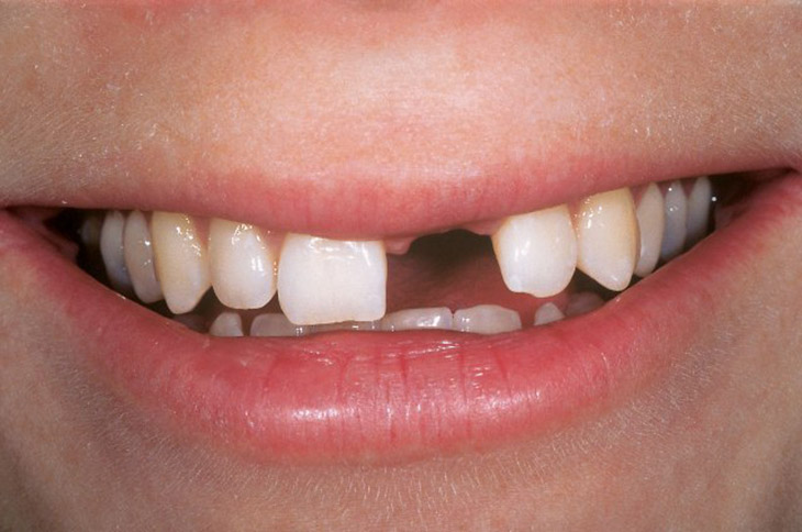 Mất răng cửa gây ra nhiều hậu quả nghiêm trọng cho người bệnh