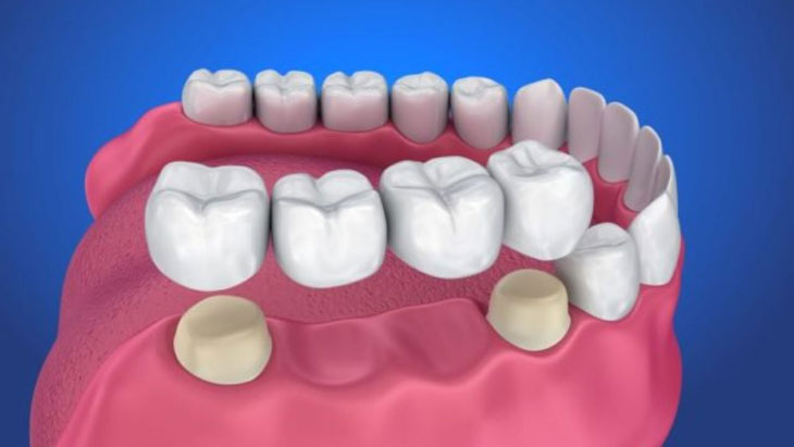 Việc mất răng sẽ để lại nhiều hậu quả nghiêm trọng sau này