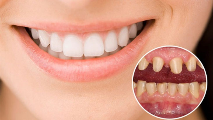 Chuyên gia giải đáp “Trồng răng giả có đau không?”