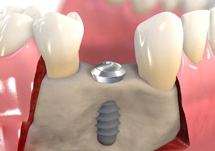 Trồng răng hàm cấy ghép implant bệnh nhân sẽ được gây tê