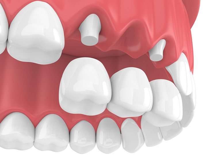Trồng răng hàm bằng cầu sứ ít gây đau đớn