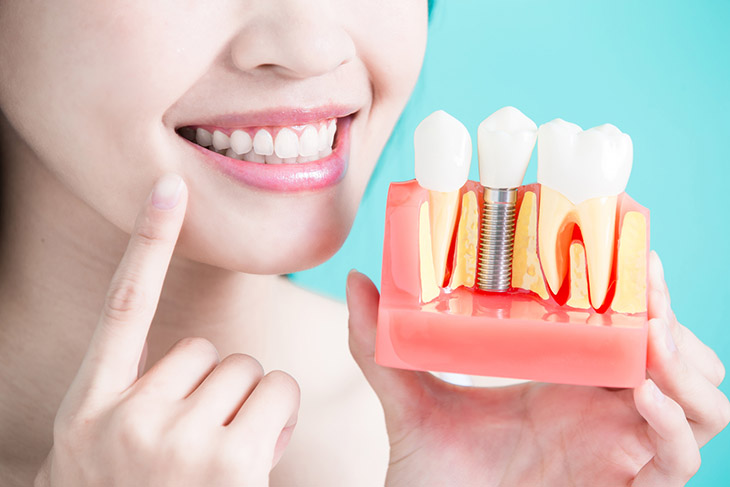 Trồng răng hàm cơn đau có thể kéo dài trong một vài ngày
