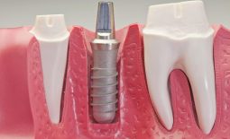 Trụ implant từ hợp chất Titanium được gắn trực tiếp vào xương hàm