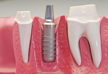 Trụ implant từ hợp chất Titanium được gắn trực tiếp vào xương hàm