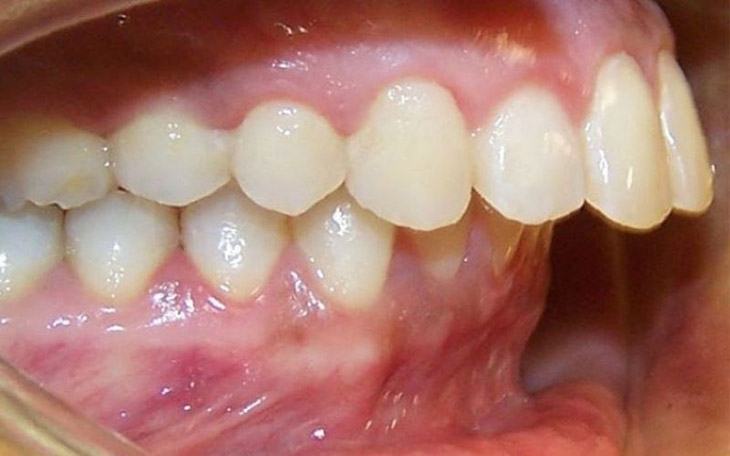Trường hợp răng bị hô, móm do xương hàm