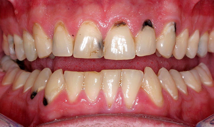 Nên bọc răng trong trường hợp nhiễm màu nặng