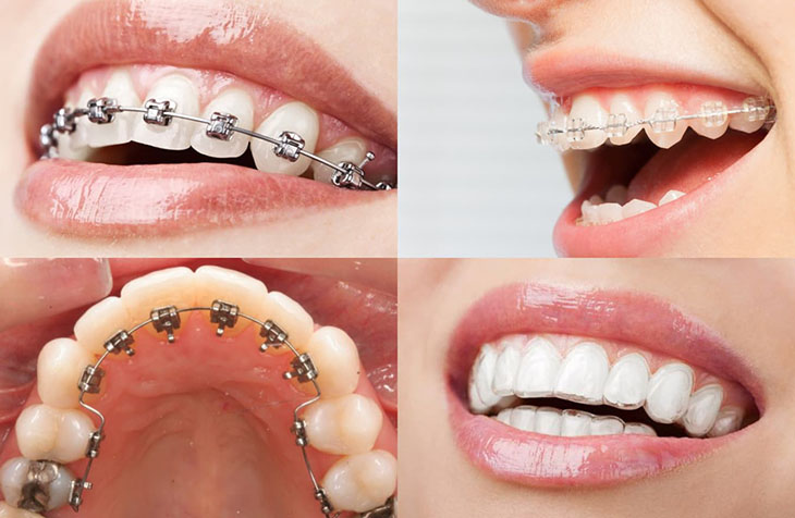 Niềng răng gíup cải thiện tính thẩm mỹ
