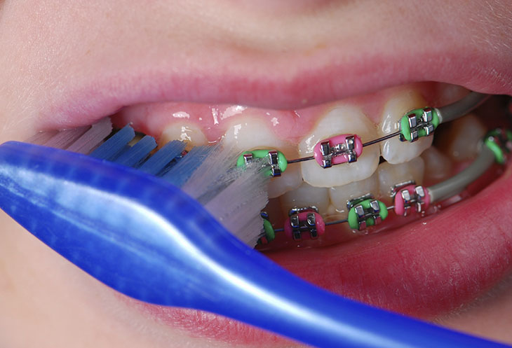 Vệ sinh răng miệng khó khăn khi niềng răng
