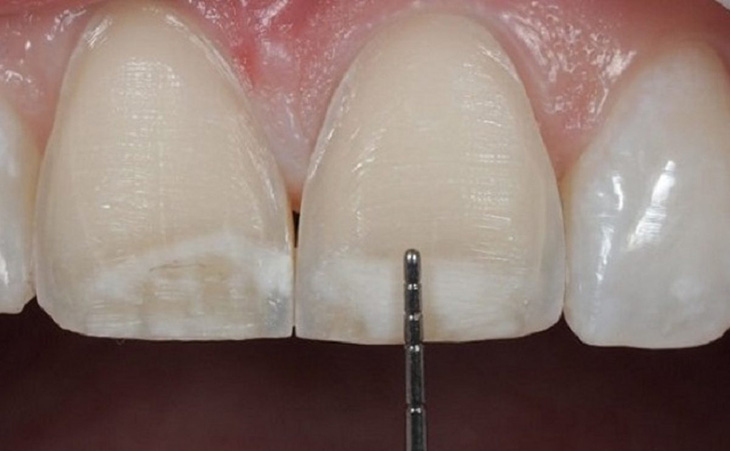 Mài răng là bước không thể tránh khỏi khi bọc răng sứ