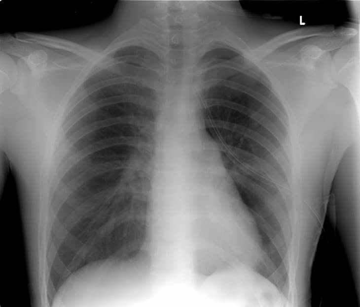 Việc chụp X quang có thể xác định những tổn thương ở phổi và các vấn đề có liên quan đến tim