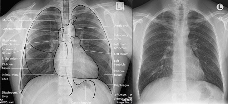 Đóng vôi trên X quang tim mạch gồm một đốm tăng độ đậm