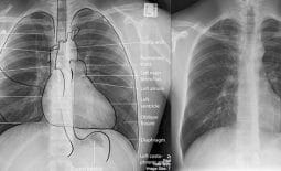 X quang ngực trong bệnh tim mạch và những thông tin liên quan