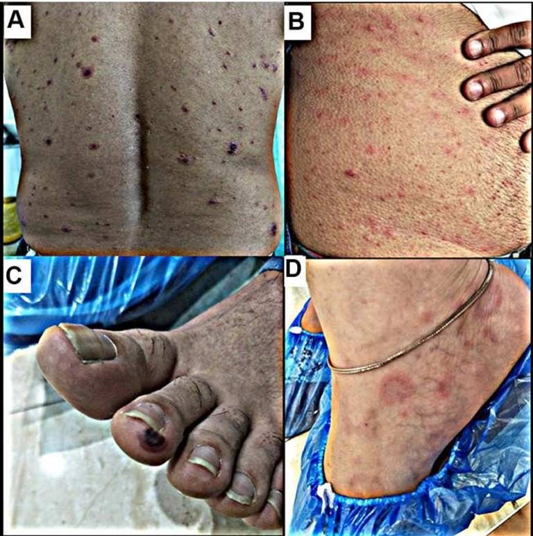 Hình ảnh phát ban, nổi mề đay cùng với những tổn thương khác trên da của bệnh nhân hậu Covid19