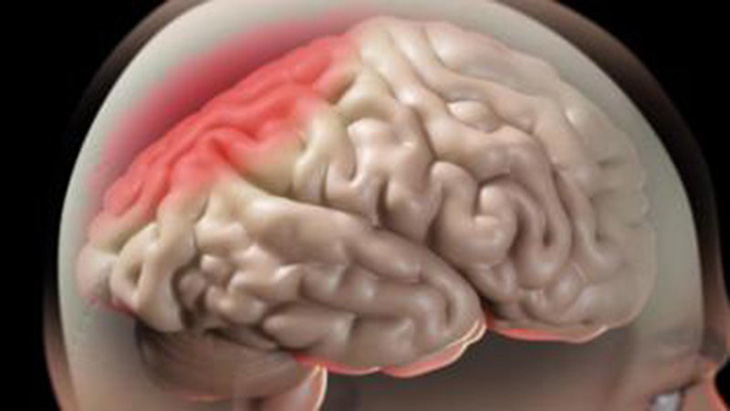 Hội chứng tăng áp lực nội sọ là sự gia tăng của áp lực trong não