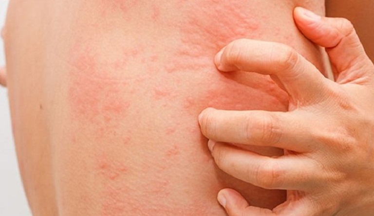 Những vùng da bị nổi mẩn ngứa tương tự như vết muỗi đốt