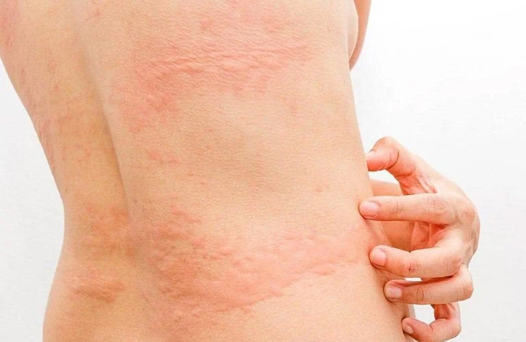 Mẩn ngứa da có thể là triệu chứng nổi mề đay