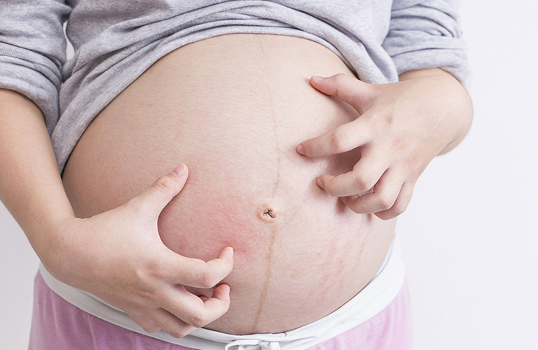 Phụ nữ mang thai thường bị mẩn ngứa da