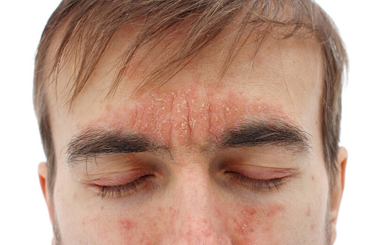 Viêm da tiết bã nhờn ở mặt gây ảnh hưởng tiêu cực đến sinh hoạt của người bệnh