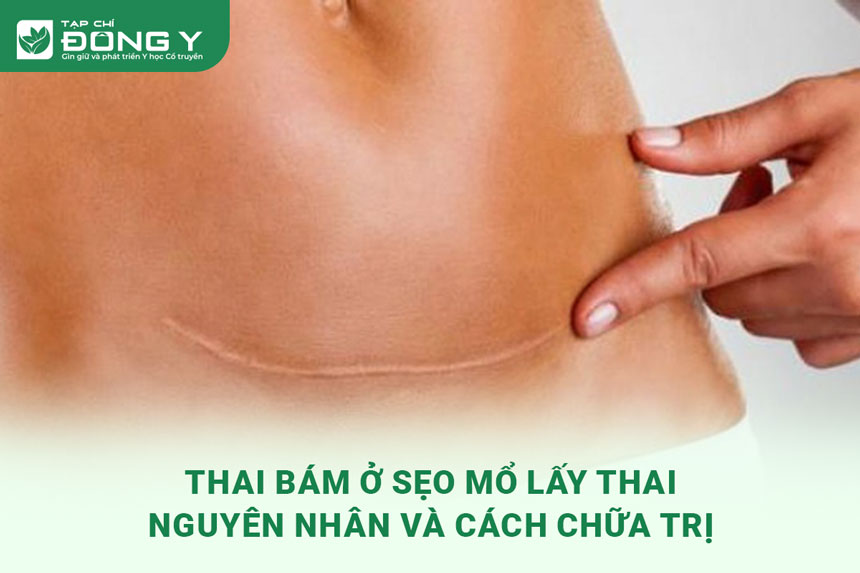 thai-bam-o-seo-mo-lay-thai