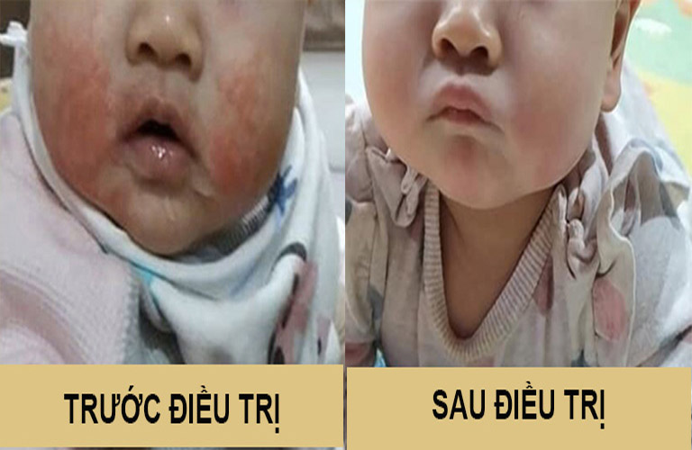 Tình trạng da của em bé trước và sau điều trị