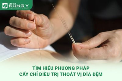 tim-hieu-phuong-phap-cay-chi-dieu-tri-thoat-vi-dia-dem