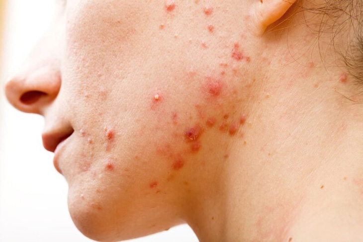 Mặt nổi mẩn đỏ ngứa không điều trị kịp thời dễ gây nhiễm trùng da
