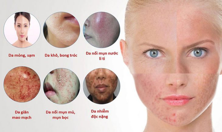 Hình ảnh da bị nhiễm độc Corticoid và các triệu chứng điển hình