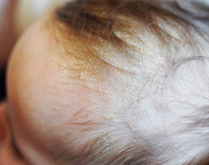 Khi bị viêm da đầu thì hạn chế sấy tóc ở nhiệt độ cao