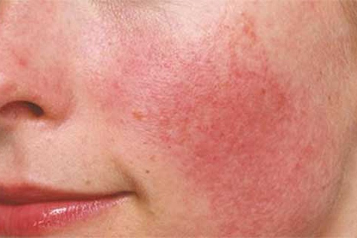 Ngứa da mặt có thể là biểu hiện của nhiều bệnh